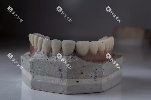 假牙展示
