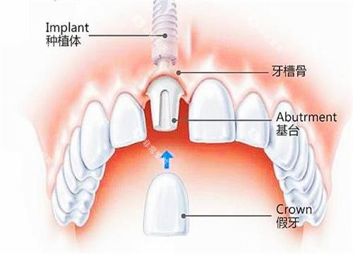 即拔即种示意图