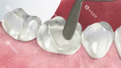 烤瓷牙素材图