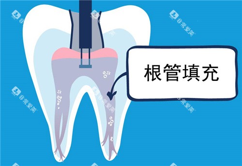 根管填充图示