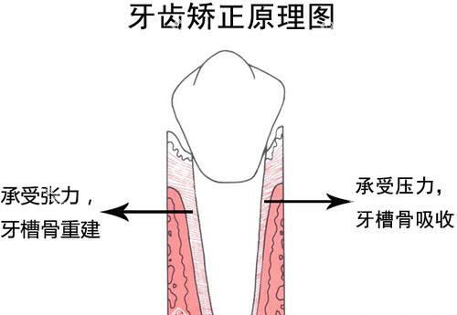 牙齿矫正正畸原理