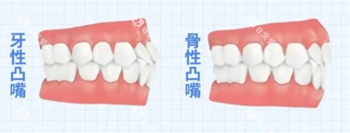 骨性凸嘴和牙性凸嘴