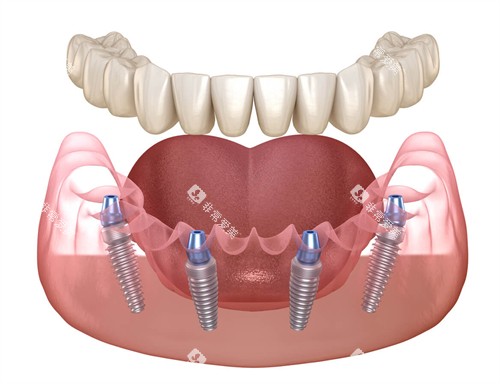 半口种植牙动画图示 半口种植牙动画图示