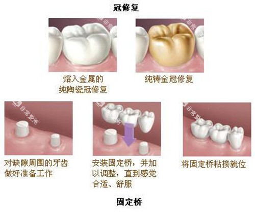 牙冠修复及固定桥展示过程