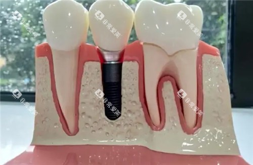 种植牙假牙模具图片 