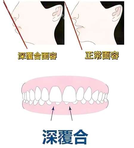 深覆合矫正前后脸型对比图片