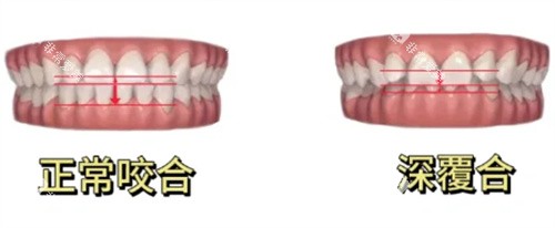 正常咬合和深覆合对比