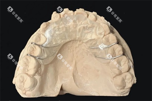 上颌平导矫正器模型展示图