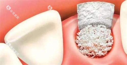 牙科骨粉示意图