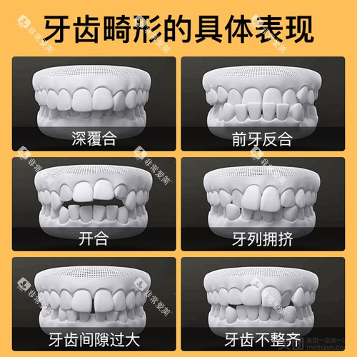 牙齿畸形形式