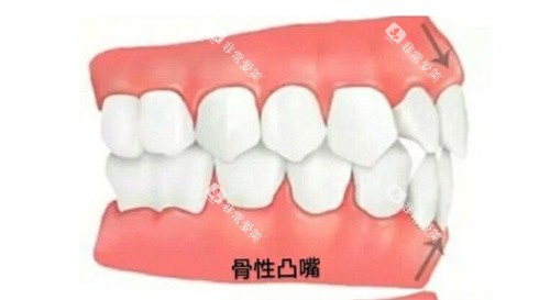 骨性凸嘴