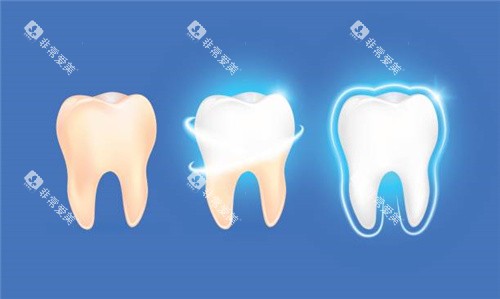 牙齿清洗后变白