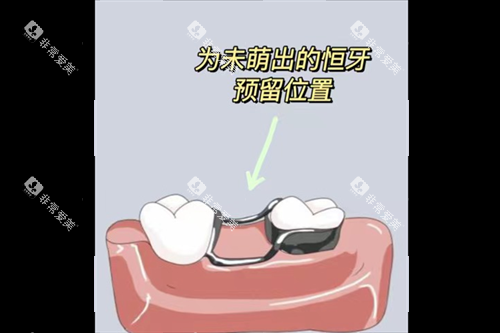 牙齿间隙保持器