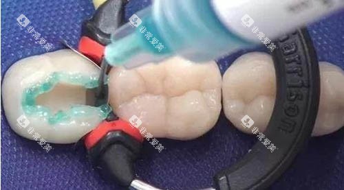 儿童补牙材料