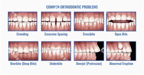 各种牙齿错合畸形问题