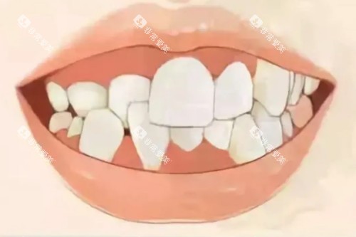 牙齿畸形卡通模型图