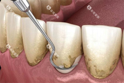 龈下刮治操作图