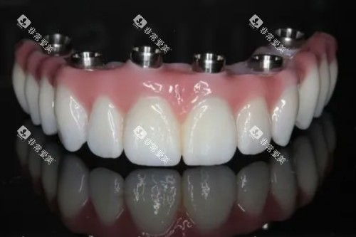 all-on-6种植图片展示