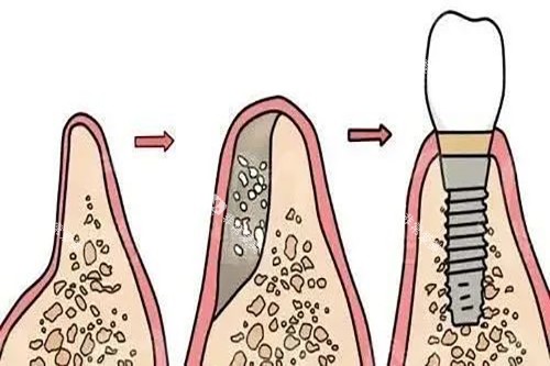 先植骨再种牙过程示意图 先植骨再种牙过程示意图