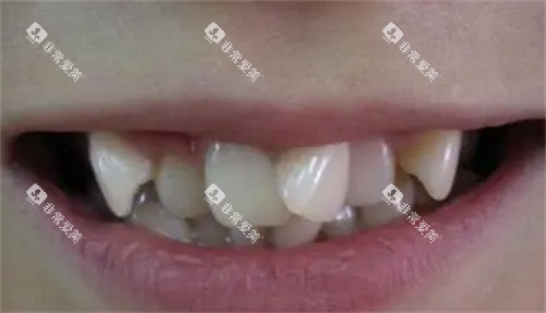 牙齿拥挤的照片