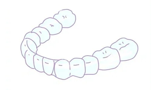隐形矫正 隐形矫正