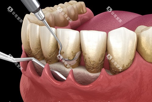 牙龈刮治卡通图 牙龈刮治卡通图