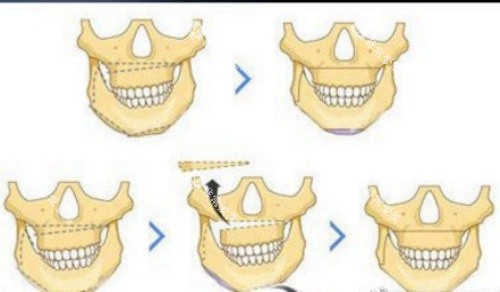 正颌流程示意图 正颌流程示意图