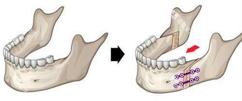 正颌手术 正颌手术
