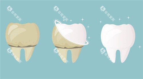 牙齿清洗前后对比