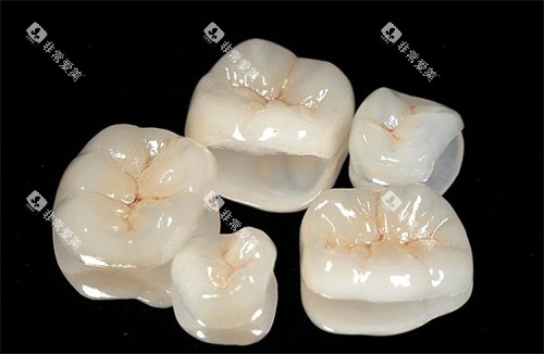 烤瓷贴面 烤瓷贴面