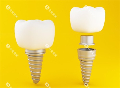 种植体结构 种植体结构