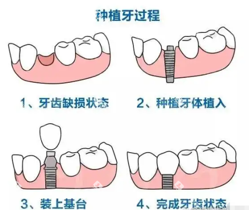 种植牙过程示意图