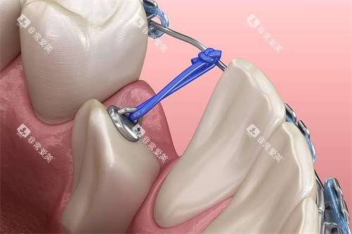 下颌单颗牙齿牵引