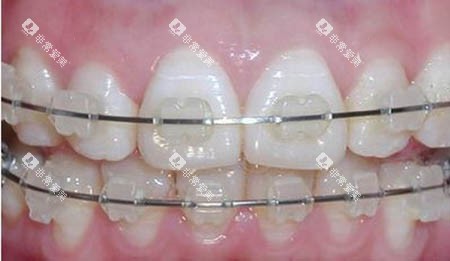 半隐形陶瓷矫正照片 半隐形陶瓷矫正照片