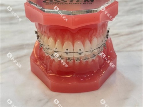 牙齿矫正陶瓷托槽牙套模型图