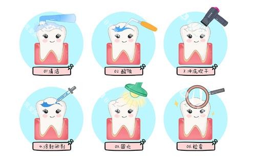 窝沟封闭治疗过程动漫图