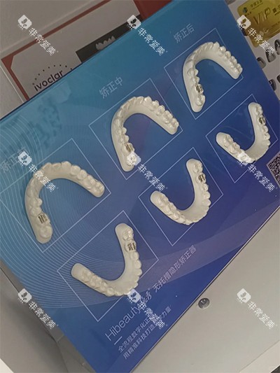 隐秀隐形牙齿矫正