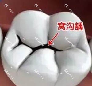 乳牙窝沟封闭