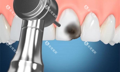 牙齿修复操作卡通图