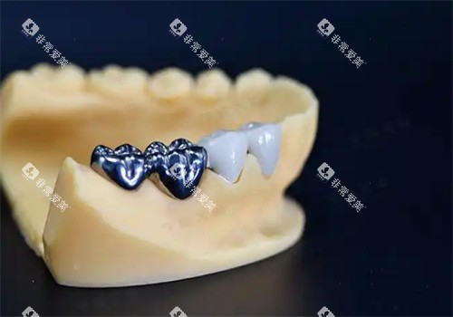 纯钛一体冠牙齿