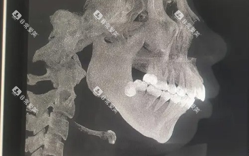 需要做正颌手术的骨骼图