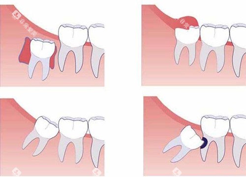 智齿不同部位示意图 智齿不同部位示意图