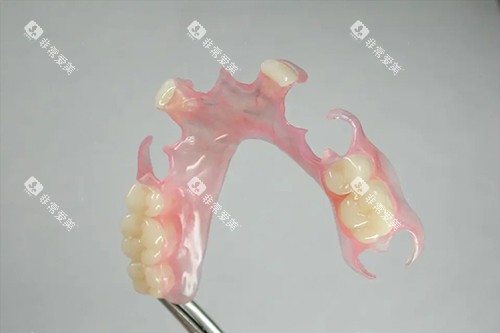 活动义齿实拍示意图 活动义齿实拍示意图