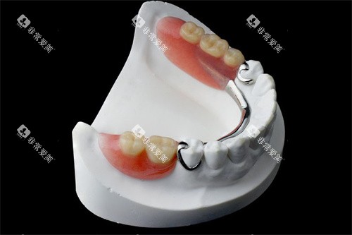 局部维他灵活动义齿 局部维他灵活动义齿