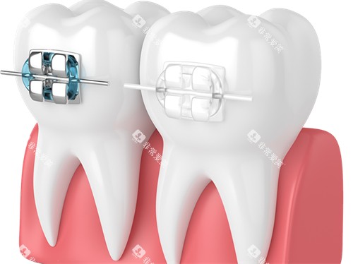 牙齿矫正金属托槽及陶瓷托槽漫画图 牙齿矫正金属托槽及陶瓷托槽漫画图
