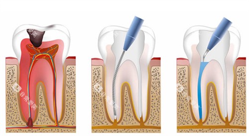 根管治疗流程图