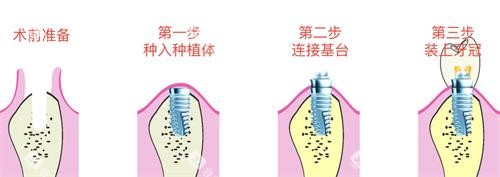 种植牙的步骤