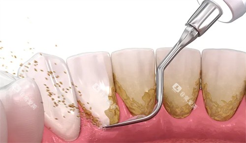 洗牙可改善牙齿污渍