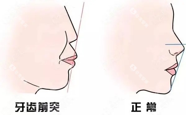凸嘴