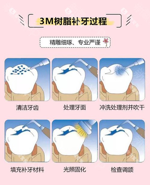 3M树脂补牙过程